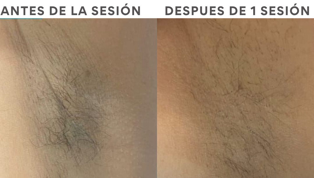Antes y después de depilación láser, resultado 1