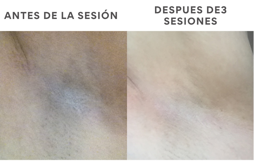 Antes y después de depilación láser, resultado 2