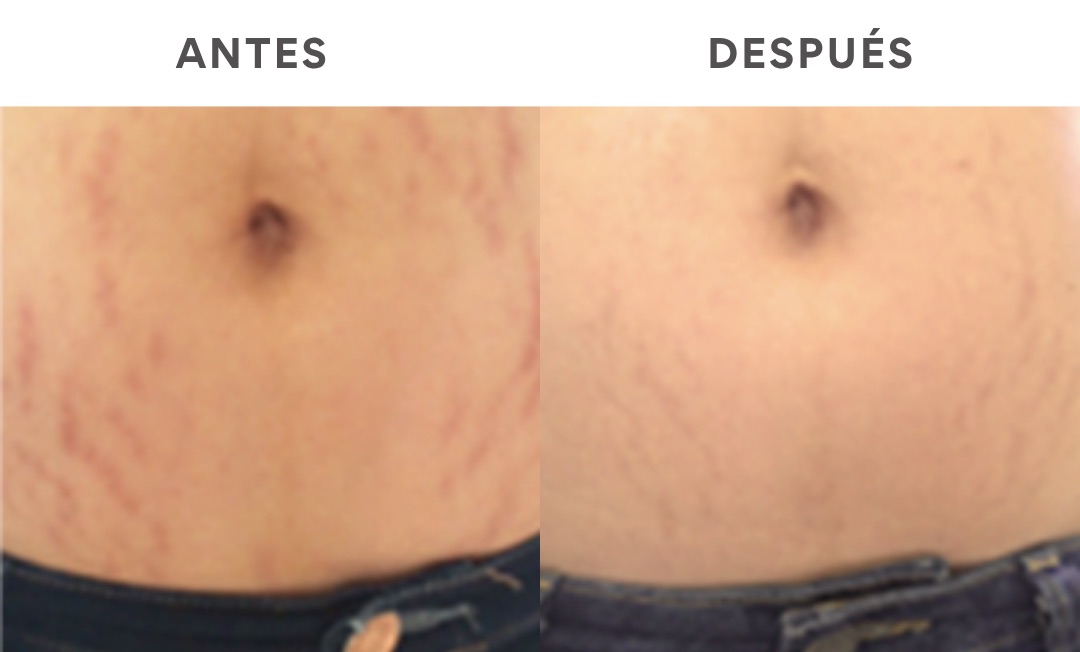 Antes y después de la reducción de estrías con láser
