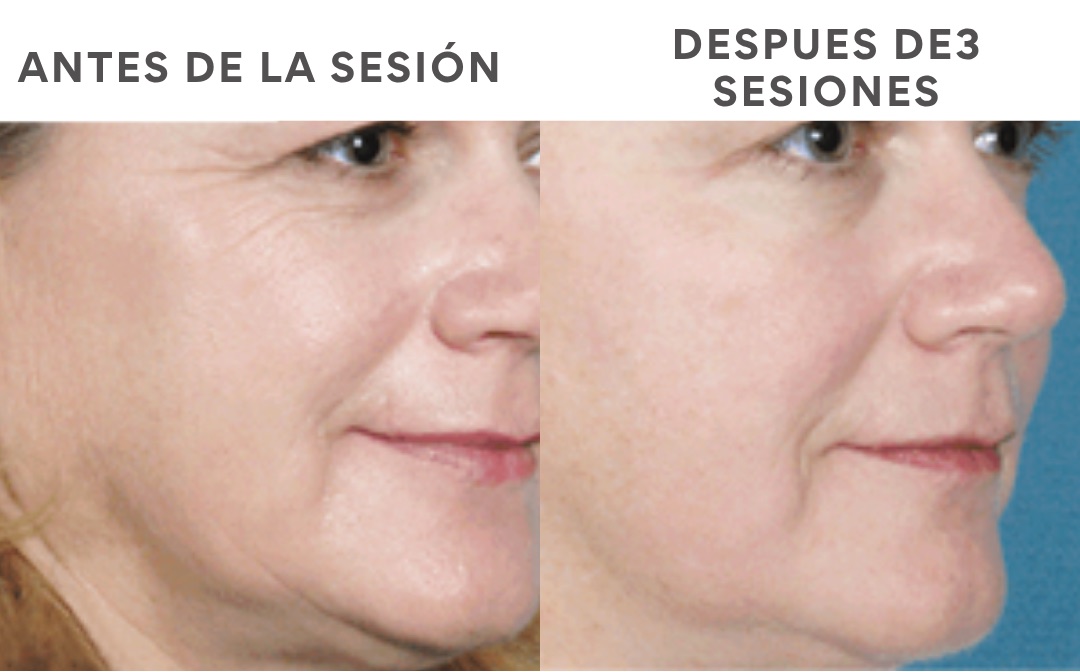 Antes y después del tratamiento GlowUp Facial con láser